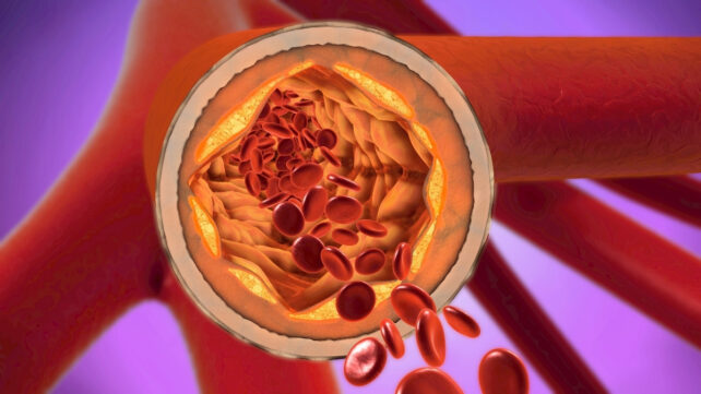 One Protein Is a Better Predictor of Heart Disease Than Cholesterol