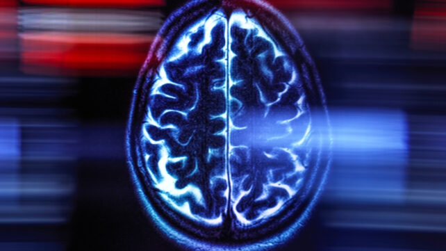 brain scan image