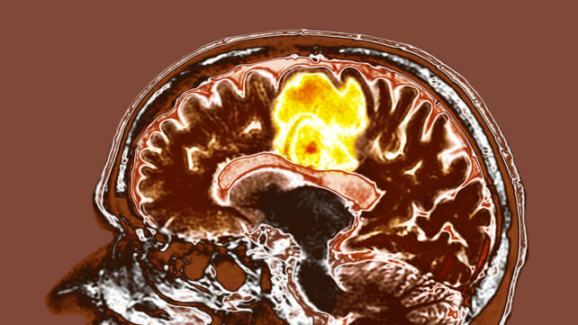 Glioblastoma brain cancer