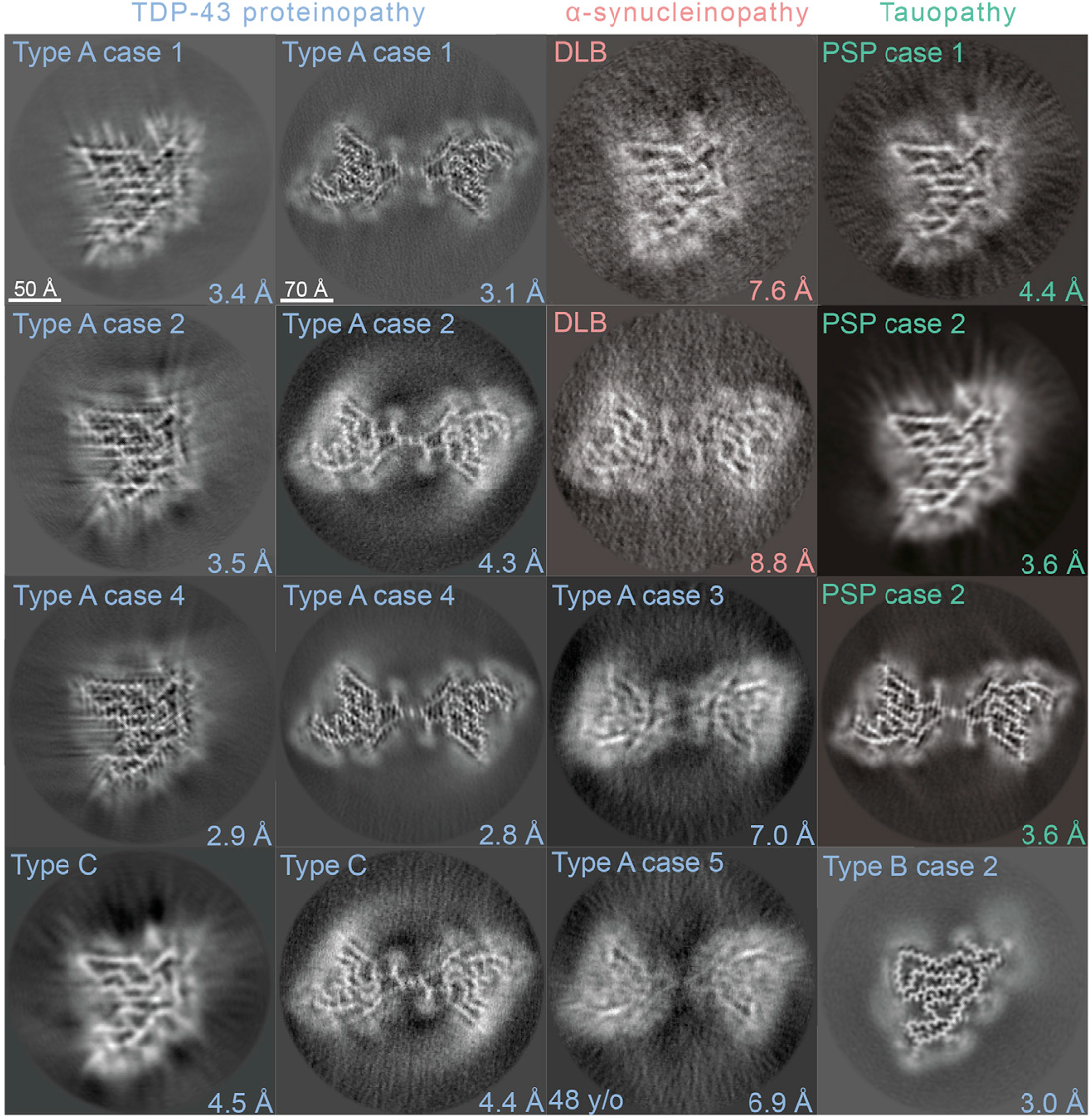 ProteinFibrilsFoundInBrainTissue